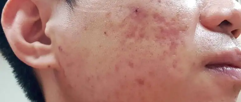 Does whey protein increase acne? Doctors remind people who are prone to acne to observe more